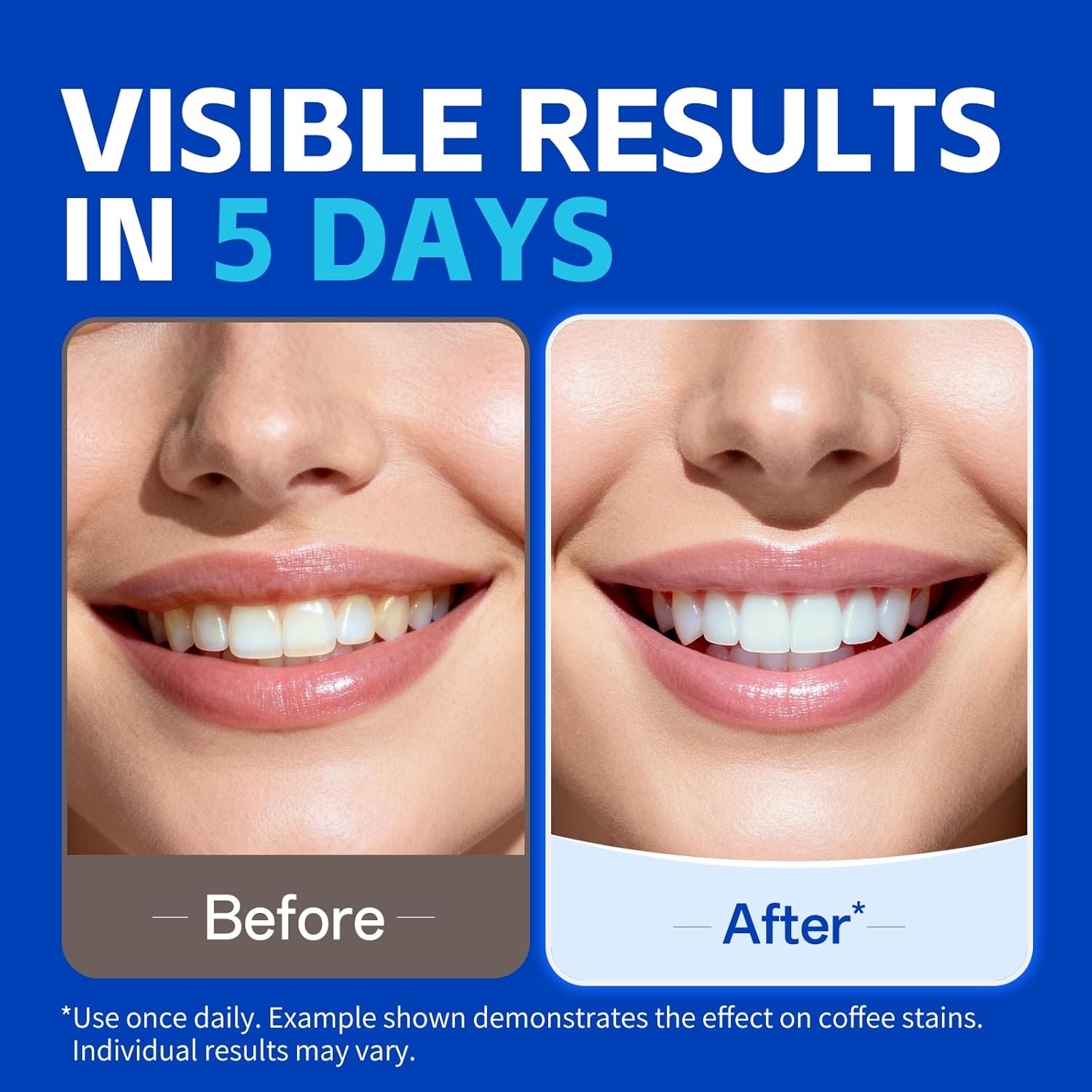 7 pares de tiras blanqueadoras - Teeth Whitening Street reseña y precio