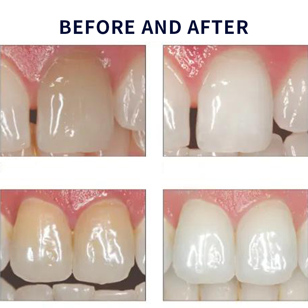 Opalescencia blanqueadora 20%  - Teeth Whitening Price reseña y precio