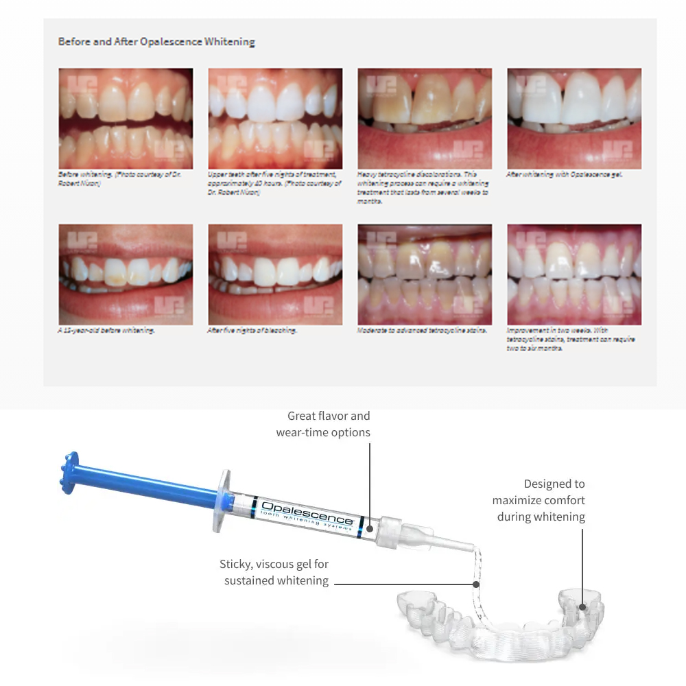 Opalescencia blanqueadora 20%  - Teeth Whitening Price reseña y precio