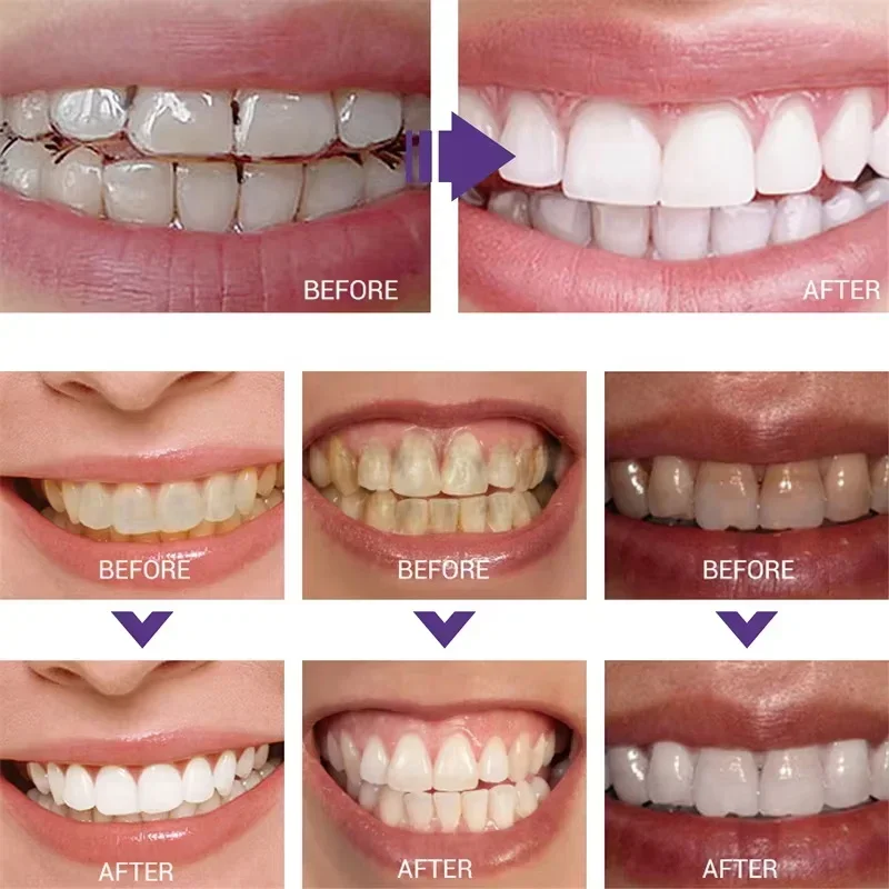 Limpieza de dientes, pasta de  - Teeth Whitening In Korea reseña y precio