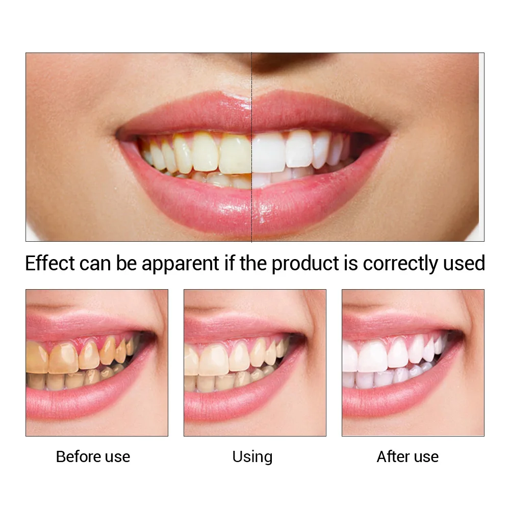 FTEENPLY-esencia para blanquea - Teeth Whitening Price reseña y precio